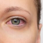 Vyome Stock (HIND) Rockets on Uveitis Study Data